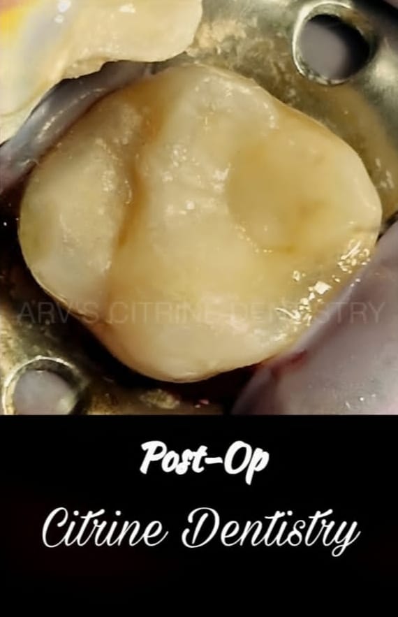 After Dental Filling