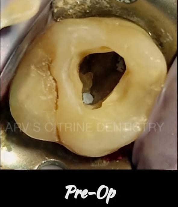 Before Dental Filling