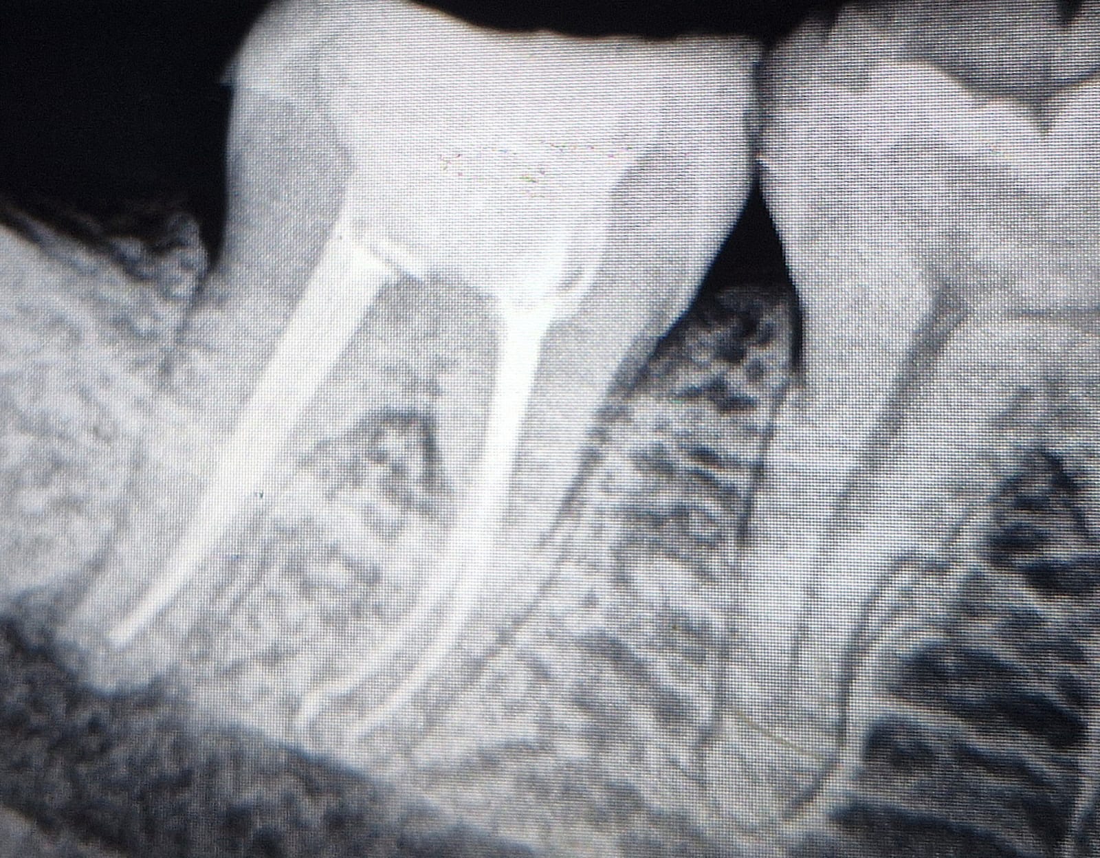 Root Canal Treatment