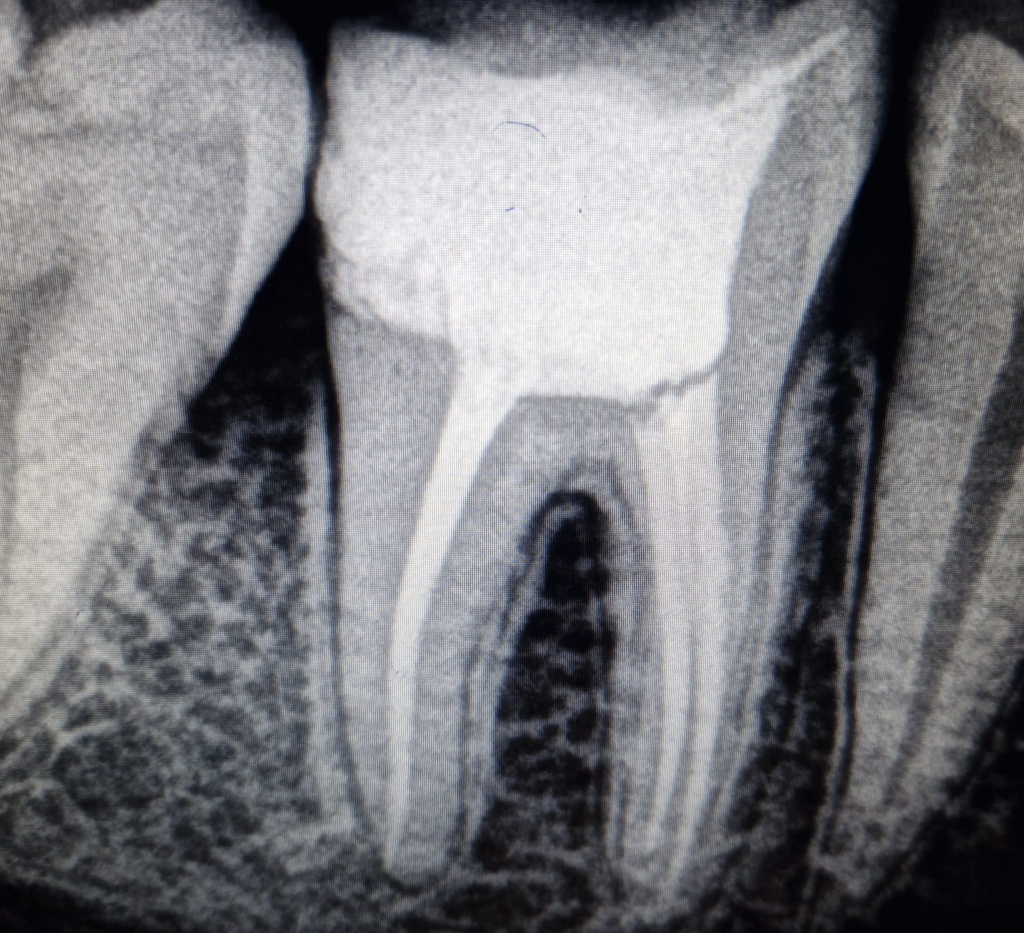Root Canal Treatment